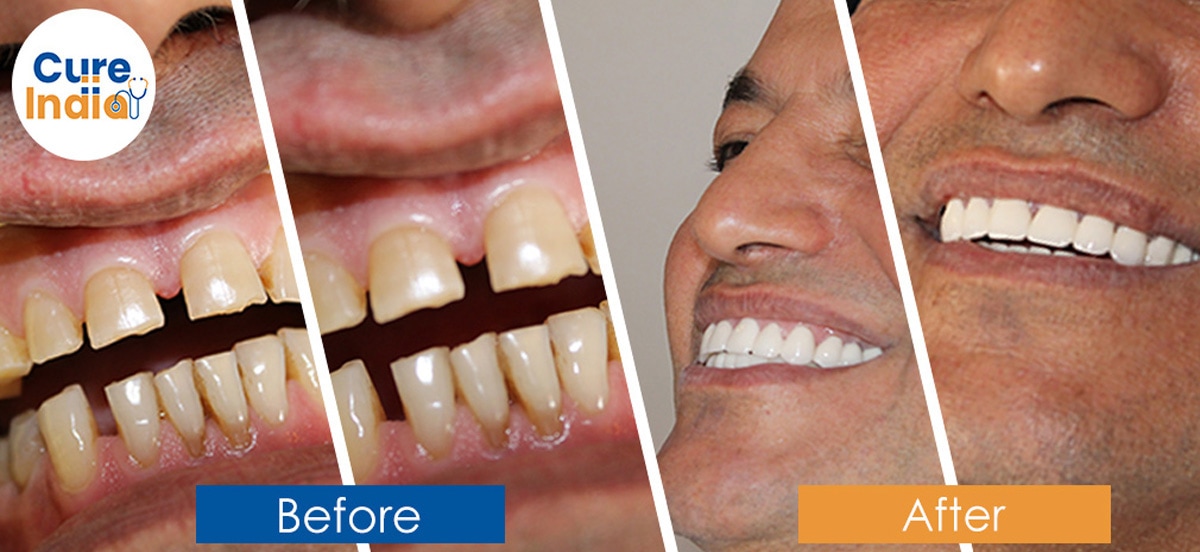 Dental Crown Before and After Case 7